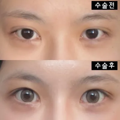 在韋伯斯整形外科做手術已經兩個月了~