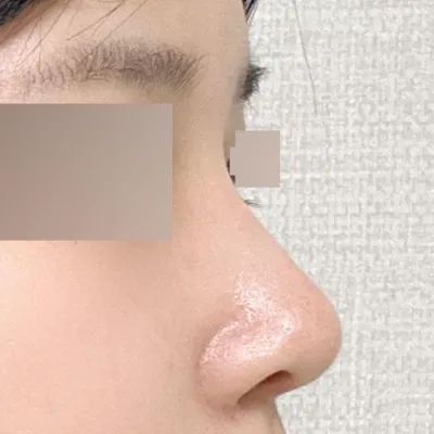 在維弗斯整形外科做手術兩個月了~