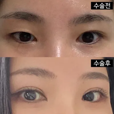 如果是雙眼皮，眼睛修復手術，我強烈推薦您來這裡