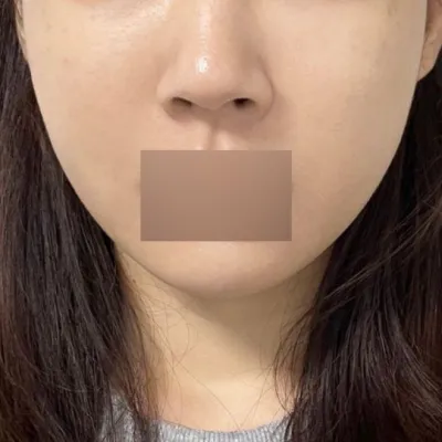 在維沃斯整形外科做了埋線拉提的第一天