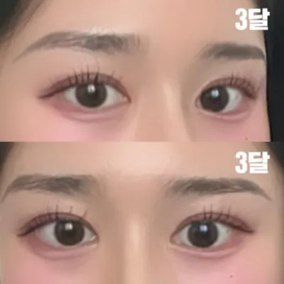 做雙眼皮手術已經3個月了。