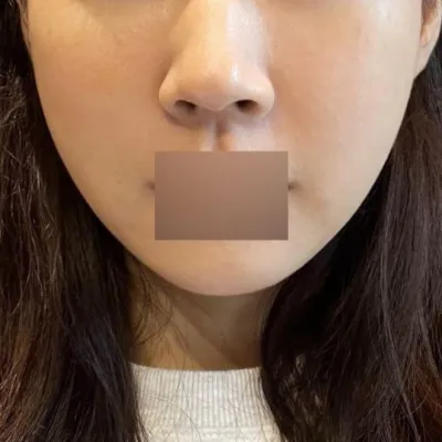 我覺得即使有浮腫，也算是不太腫的了