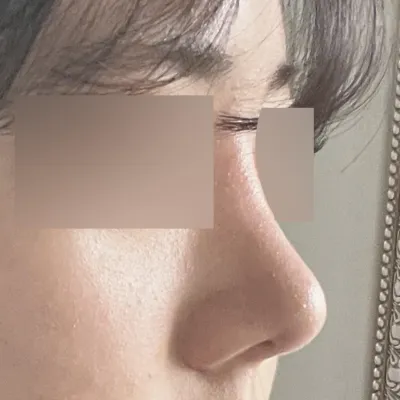 鼻部修復手術還是Wevers最棒