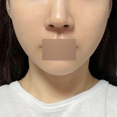 埋線拉提兩週了，效果真的很明顯！