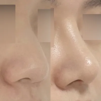 做了鼻頭整形無假體手術