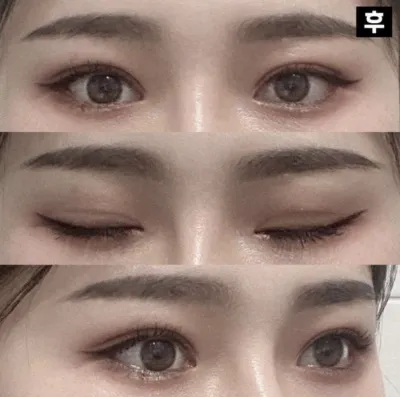 比手術前更漂亮，我很喜歡也很滿意！