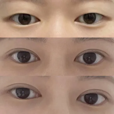 用切開法成功做了纖細的雙眼皮