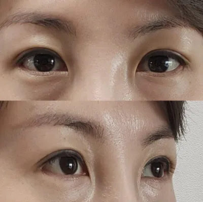 一想到就非常激動！我覺得做手術做得很好