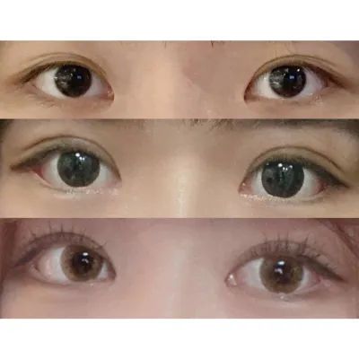 後眼瞼下至+自然黏連+眼部矯正後記！