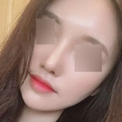 在Weverse做了隆鼻手術已經三個月了！