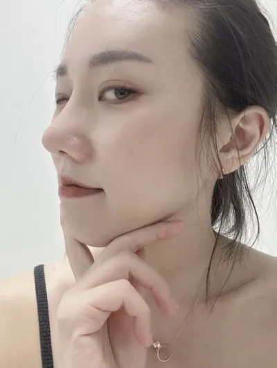 第一次隆鼻手術，這樣算成功嗎？