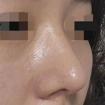 苦惱了很久才進行的手術，一點也不覺得浪費錢，非常幸福！