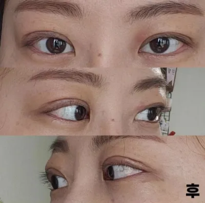 我覺得做手術真是太好了