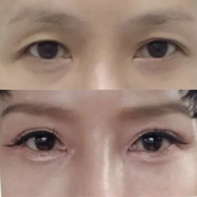 腫脹很快就消退了，效果很好