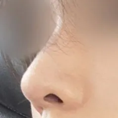 大家都說我做得非常自然，都看不出來我做了隆鼻手術。