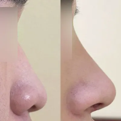 低鼻子和下垂鼻整形手術後記