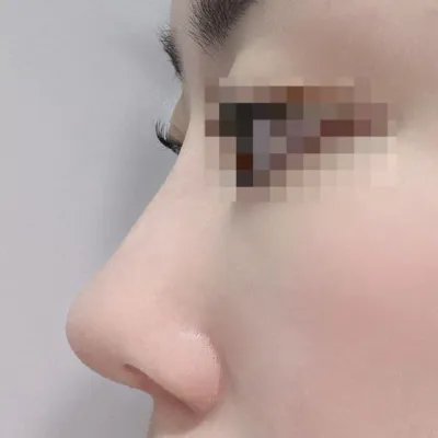 我很喜歡！非常期待一個月後消腫的樣子！