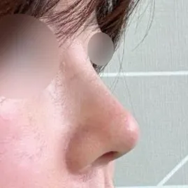 我也被術前術後的照片差異嚇了一跳 哈哈