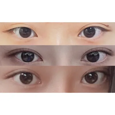 眼睛、鼻子一起做了手術ㅎㅎ
