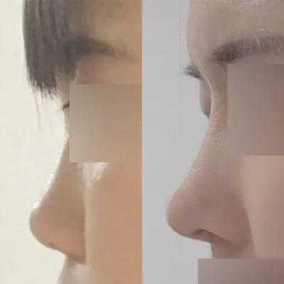 做完眼鼻手術已經8個月了！