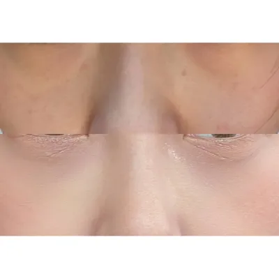 改善了看起來疲憊的眼下脂肪，呵