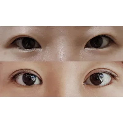 做完眼部手術一個多月了