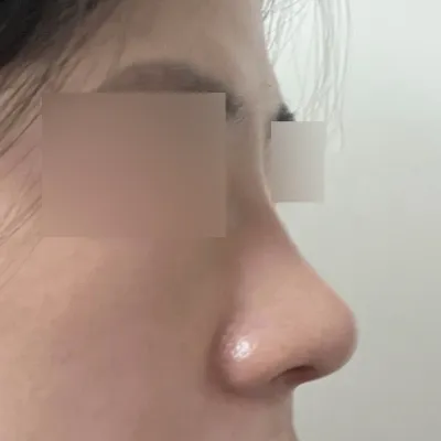 做了縮鼻頭手術