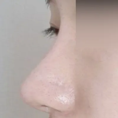 一起做了鼻炎手術和隆鼻手術！