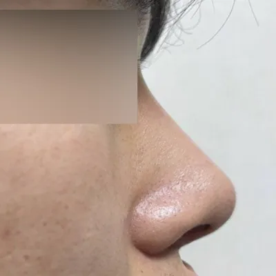 在沈院長那裡做了隆鼻手術已經兩個月了