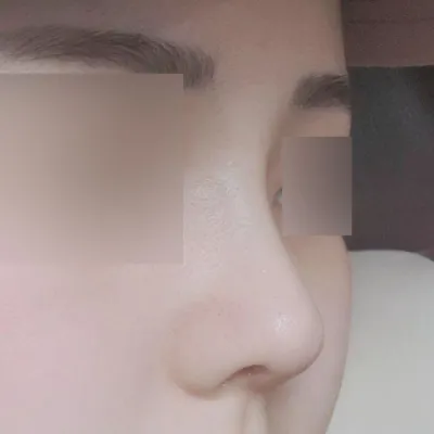 做完鼻子手術一個月了