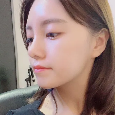 在Wivers整形外科做完隆鼻手術一個月了