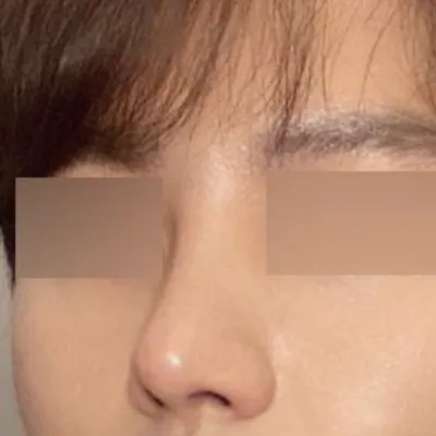 鼻子第三次重修手術/眼睛第一次手術後記