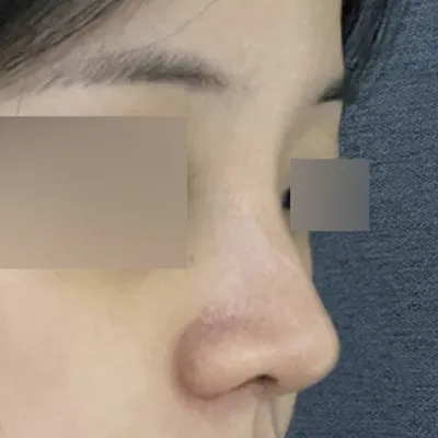 手術已經兩週了