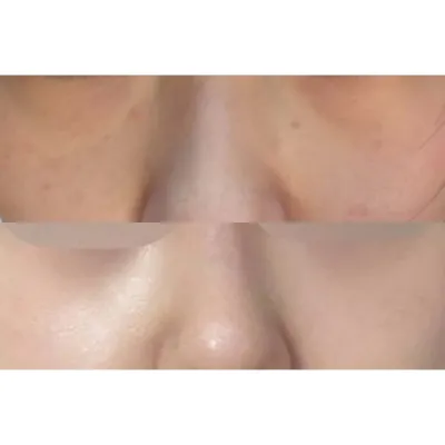 我做了沈正煥院長的眼底脂肪重置手術！