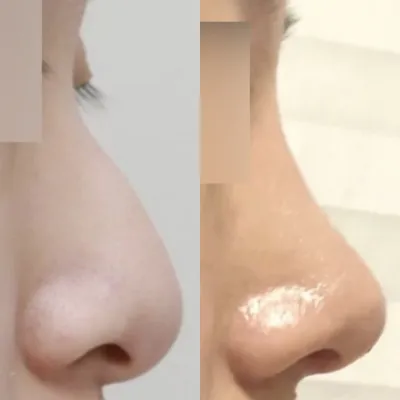 第一次做鼻部整形手術，沒有植入假體！