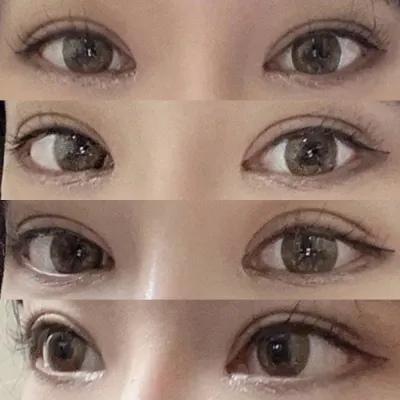 做了雙眼皮矯正手術！