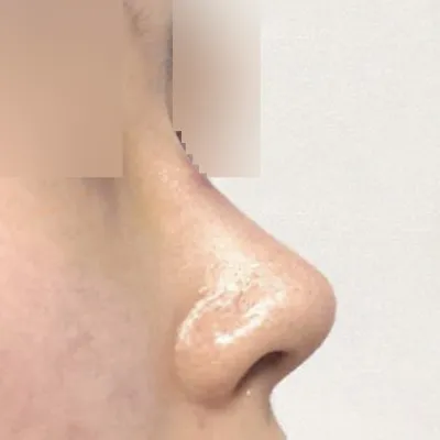 做了下垂的鼻尖手術