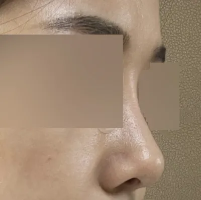 手術後三個月多一點的後記～