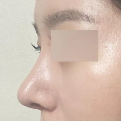 做了蒜頭鼻手術兩週了