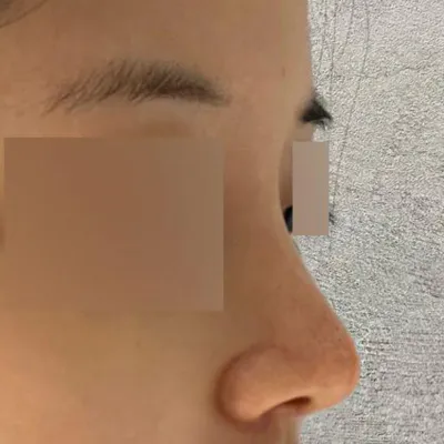 手術已經兩個月了