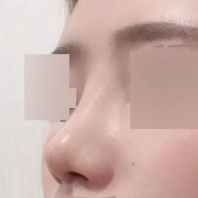 做了蒜頭鼻再手術！