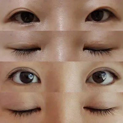 做了眼部手術2個月了