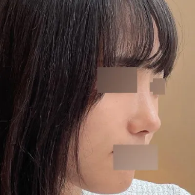 做了鼻頭縮小手術3個月了