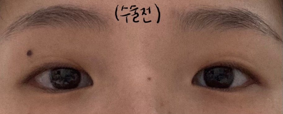 埋線+開眼頭後記