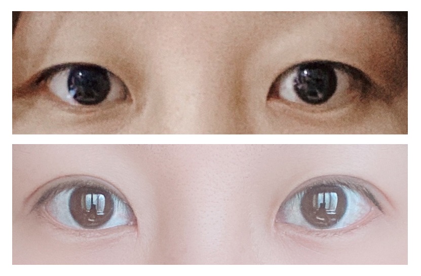 雙眼皮3個月後記