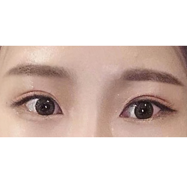 割雙眼皮+眼型矯正一個月了