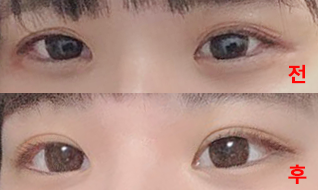 雙眼皮手術成功了