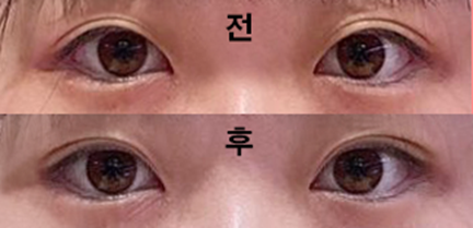 用縫雙眼皮的方式做了手術!