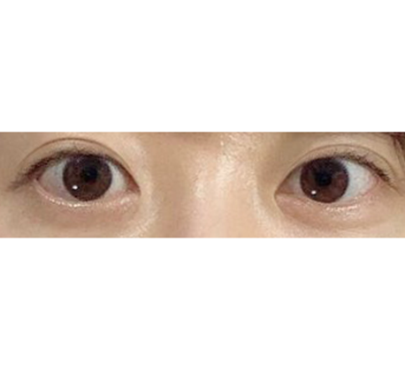 眼型矯正做得太自然啦！