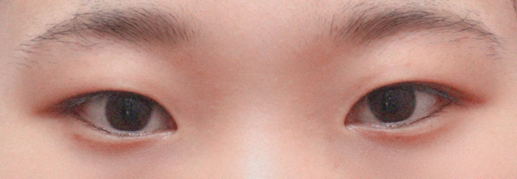 割雙眼皮+開眼頭手術一個月後